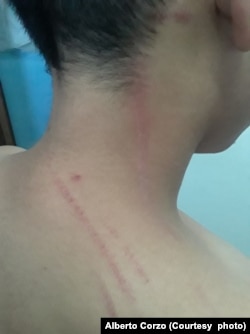 Injuries sustained by Alberto Corzo's son Raidel who was attacked by children. Corzo said a teacher and adults encouraged children to attack his son.