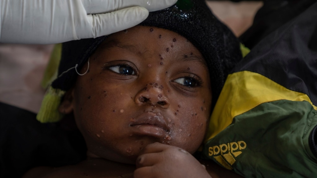 Mpox Cases in DRC Might Be Decreasing