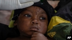 FILE - Emile Miango, 2, who has mpox, lies in a hospital, in Kamituga, South Kivu province, Sept. 4, 2024, in the Democratic Republic of Congo. (AP Photo/Moses Sawasawa, file)