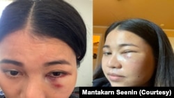 Mantakarn Seenin, A Thai woman shows her wounds on her face caused by brutally attacked while riding the BART train in San Francisco, CA.