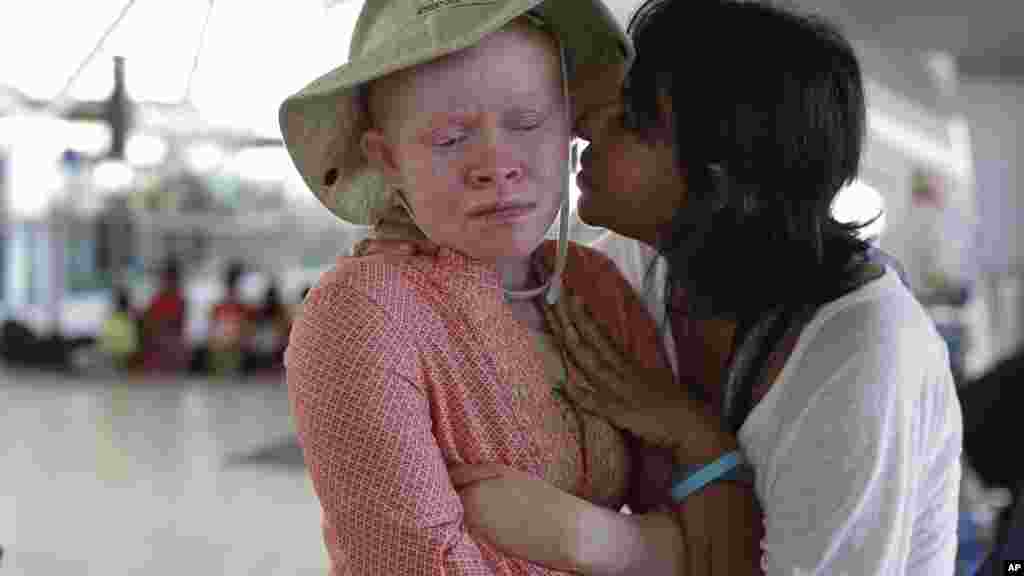 Albino Children Prosthetics