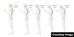 This chart shows the stress put on the neck and spine as a result of hunching over a smartphone (Courtesy Dr. Ken Hansraj M.D.)