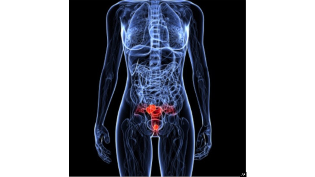 La OMS subraya la necesidad de usar la vacuna para prevenir el cáncer cervicouterino.