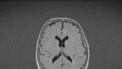 Cambios cerebrales debido a migrañas