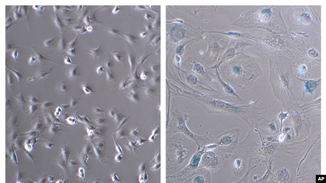 This combination of microscope photos provided by the Mayo Clinic in August 2022 shows healthy myoblast cells, left, and senescent ones. Senescent cells resist apoptosis, or programmed cell death, and characteristically get big and flat. (Dr. Xu Zhang/Mayo Clinic via AP)