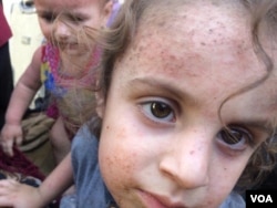 Children fleeing Old Mosul are often covered in rashes parents say are caused by bad food, lack of water and the heat, in Mosul, Iraq, July 5, 2017. (H. Murdock/VOA)