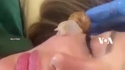 Terapi Kulit Wajah dengan Siput Albino di Suriah