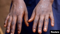 Sumaya Hatungimana, 12 ans, montre des cicatrices sur ses mains après avoir guéri du mpox. Bujumbura, 28 août 2024. Reuters / Ngendakumana Evrard