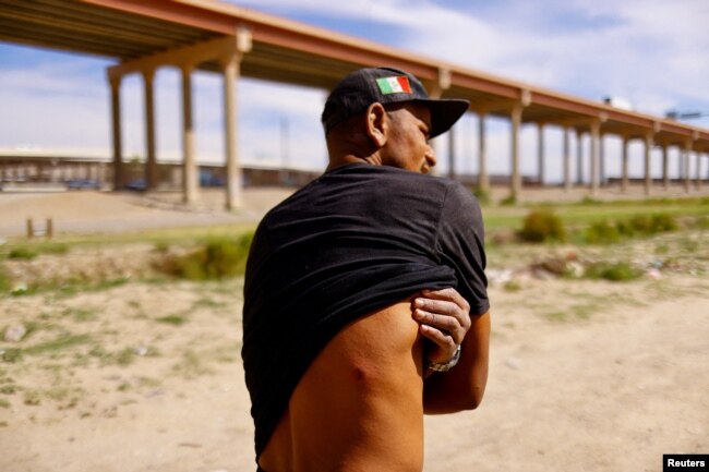 El migrante venezolano Eli Segura muestra una herida de bala de goma que supuestamente recibió cuando agentes fronterizos de EEUU dispararon contra una protesta en Ciudad Juárez, México, el 31 de octubre de 2022.