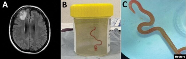 A supplied undated combined image obtained on August 28, 2023 shows a live "Ophidascaris robertsi" roundworm found in a 64-year-old Australian woman's brain. (AAP Image/Supplied by Emerging Infectious Diseases via REUTERS)