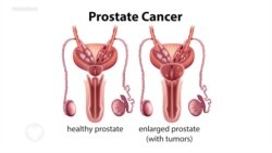 በወንዶች መራቢያ አካላት ላይ ጉዳት የሚያደርሰው ፕሮስቴት ካንሰር 