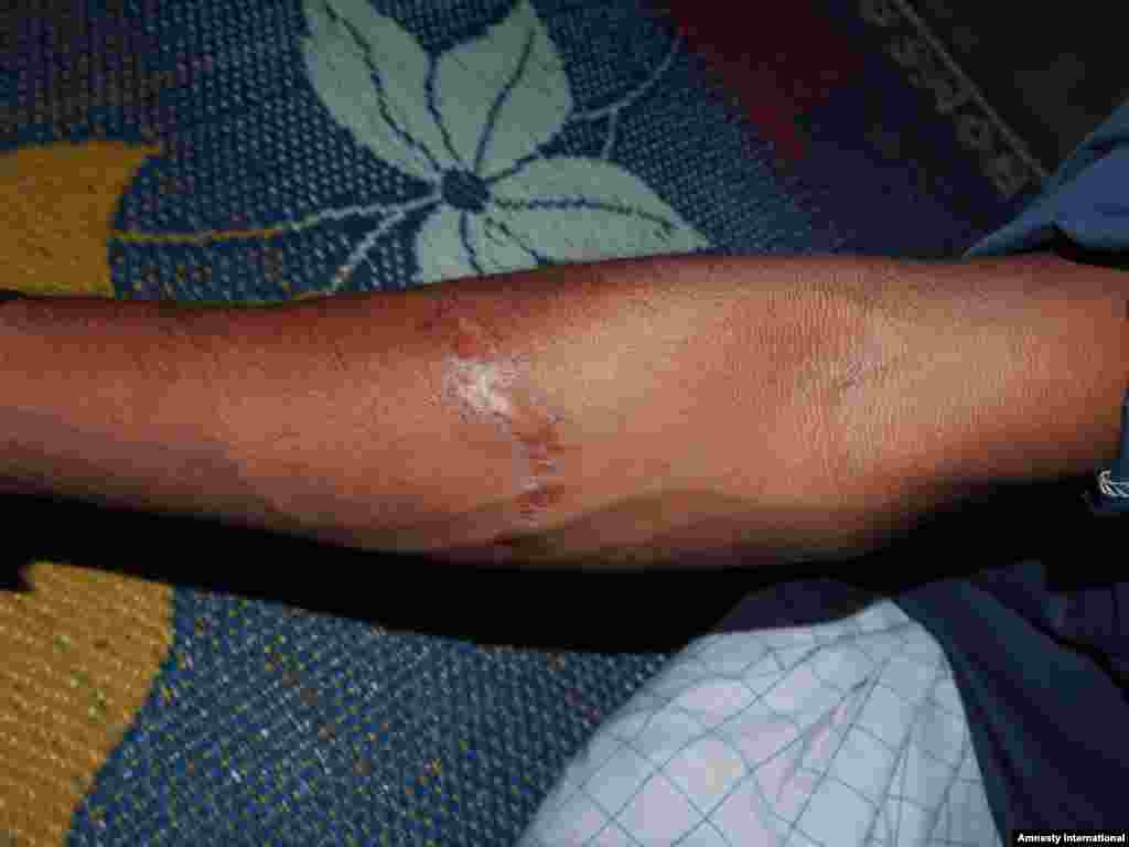 Rohingya man showing scar from knife attack in Myanmar.