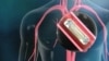 New Device, New Studies Hold Out Hope for Heart Patients