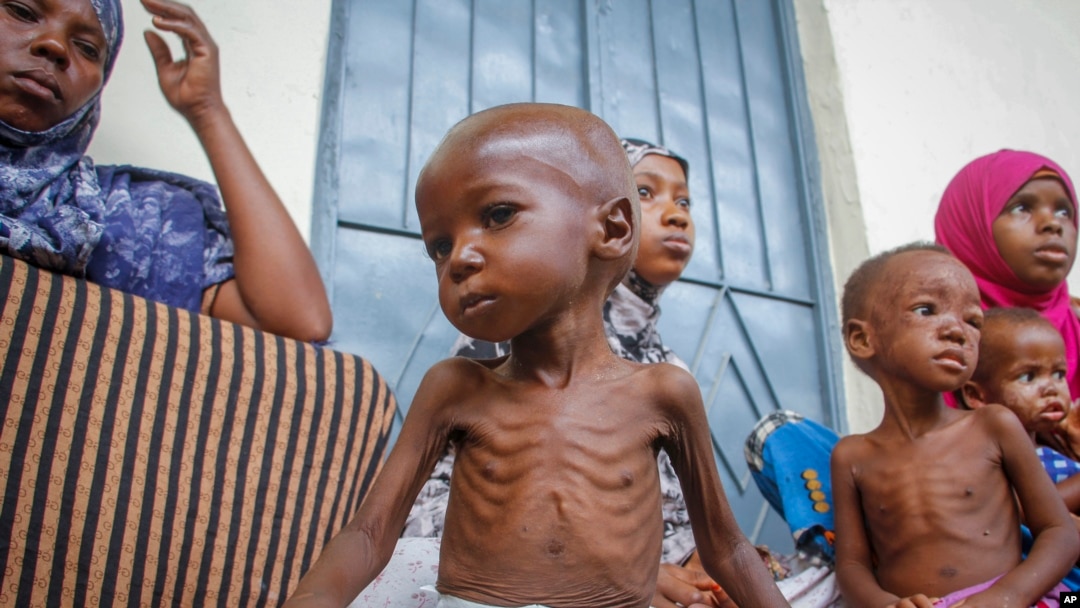 Seorang anak laki-laki berusia dua tahun yang kekurangan gizi duduk di sebelah ibunya (kiri), di sebuah pusat malnutrisi yang dikelola oleh Action Against Hunger, di Mogadishu, Somalia, pada 5 Juni 2022. (AP/Farah Abdi Warsameh)