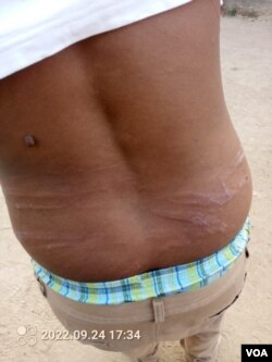 Assaulted CCC member showing whip marks