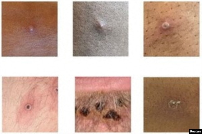 Pictures showing examples of rashes and lesions caused by the monkeypox virus are seen in this undated handout image obtained by Reuters on July 1, 2022. (UK Health Security Agency/Handout via REUTERS)