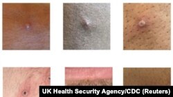 Contoh ruam dan lesi yang disebabkan oleh virus monkeypox terlihat pada gambar handout yang diperoleh dari situs resmi CDC pada 1 Juli 2022. (Foto: via Reuters)