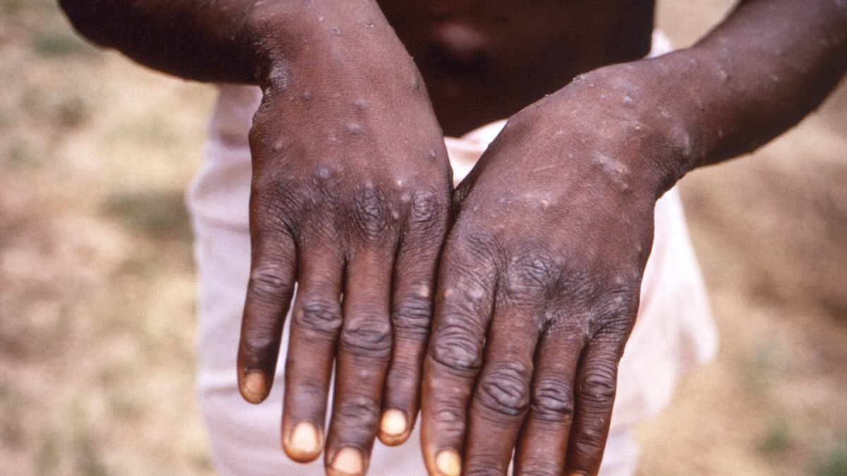 India Reports First Death from Monkeypox