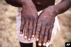 FILE - This 1997 image provided by the CDC during an investigation into an outbreak of monkeypox, which took place in the Democratic Republic of the Congo (DRC), and shows the dorsal surfaces of the hands of a monkeypox case patient.