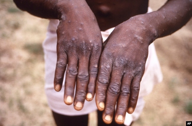 FILE - This 1997 image provided by the CDC during an investigation into an outbreak of monkeypox, which took place in the Democratic Republic of the Congo (DRC), and shows the dorsal surfaces of the hands of a monkeypox case patient.