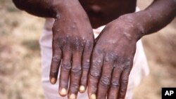 Foto Achiv: Foto CDC sa a montre men yon moun ki gen varyol senj la nan Repiblik Demokratik Congo (RDC). 