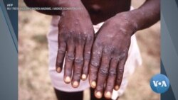 US Expands Monkeypox Response After WHO Declares Emergency