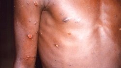 မျောက်ကျောက်ရောဂါ (Monkeypox) ကာကွယ်ရေး
