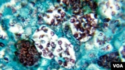 Produce la histoplasmosis, enfermedad respiratoria parecida a la gripe que combina otros síntomas como decaimiento. Clínica Mayo explica que se desarrolla al respirar esporas de este hongo que suelen encontrarse en excrementos de pájaros y murciélagos. Los entornos de riesgo son espacios cerrados donde se haya acumulado el germen y puede esparcirse durante proyectos de limpieza o demolición. Está presente en regiones de EEUU, centro y Sudamérica, África, Asia y Australia. (Ilustración CDC)