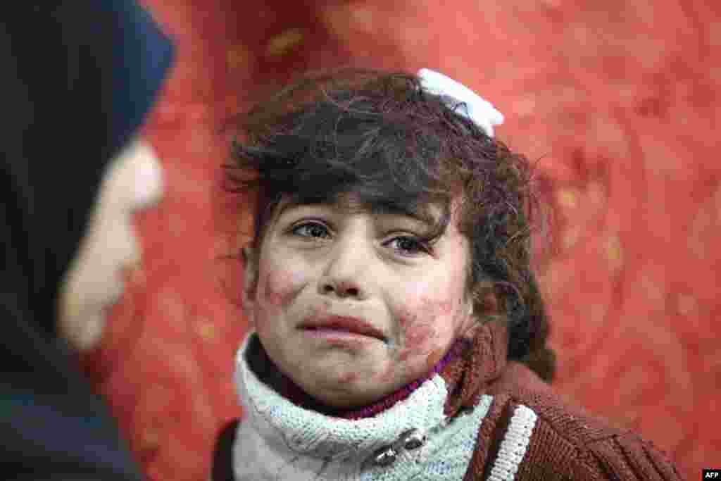 Hala, anak perempuan berusia 9 tahun yang mengalami luka-luka, menjalani perawatan di sebuah klinik darurat, setelah pasukan Suriah membombardir kota Saqba, Ghouta timur di luar ibu kota Damaskus.