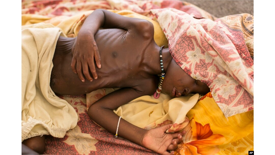A severally malnourished child lies on the bed at MSF hospital Bentiu, South Sudan, July 3, 2014.