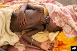 A severally malnourished child lies on the bed at MSF hospital Bentiu, South Sudan, July 3, 2014.