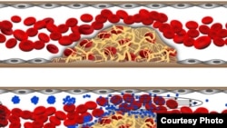 Clusters of nanoparticles break apart and release an anti-clotting drug when they encounter vascular narrowing. (Graphic courtesy of Wyss Institute) 