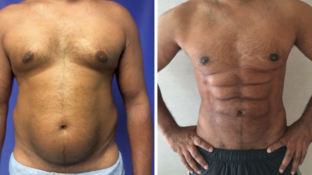 Forget Exercising: Surgeons Can Make the Stomach Look Muscular