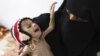 A woman holds her malnourished child at a feeding center at al-Sabyeen hospital in Yemen's capital, Sanaa, June 20, 2012.