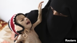 FILE - A woman holds her malnourished child at a feeding center at al-Sabyeen hospital in Yemen's capital, Sana'a.