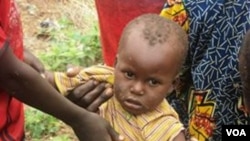 Un petit Camerounais, soigné pour malnutrition