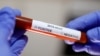 ILUSTRACIJA - Epruveta sa testom na koronavirus (Foto: Reuters/Dado Ruvić)