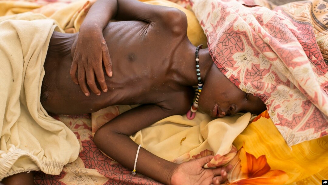 Một trẻ em bị suy dinh dưỡng trầm trọng nằm trên giường ở bệnh viện MSF Bentiu, Nam Sudan, ngày 03/7/2014.