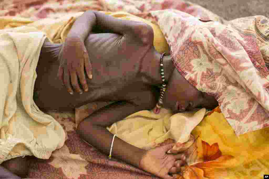 A severely malnourished child lies on the bed at a hospital in Bentiu, South Sudan, run by medial charity Doctors Without Borders, on July 3, 2014.