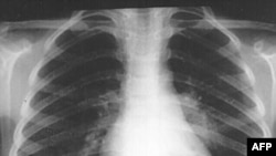 Analizë e re për diagnostikimin e TBC
