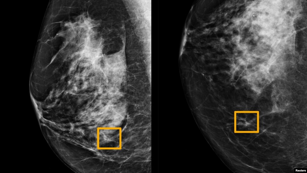 Hình vuông màu vàng cho thấy nơi hệ thống trí tuệ nhân tạo (AI) phát hiện ung thư nằm lẫn trong tế bào vú (ảnh do trường đại học Tây Bắc Chicago công bố ngày 1/1/ 2020) 