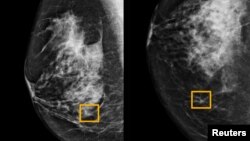 Hình vuông màu vàng cho thấy nơi hệ thống trí tuệ nhân tạo (AI) phát hiện ung thư nằm lẫn trong tế bào vú (ảnh do trường đại học Tây Bắc Chicago công bố ngày 1/1/ 2020) 
