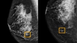 Quiz - Google System Could Improve Breast Cancer Detection