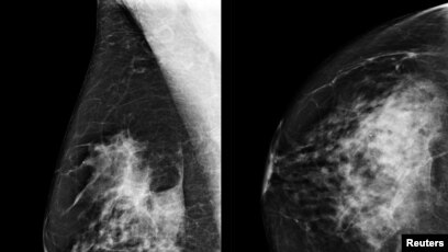 AI-Support Mammogram Screening Increases Breast Cancer Detection