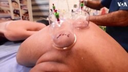 Iraqis Revert to Cupping in Hopes of Speeding COVID-19 Recovery 