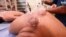 Iraqis Revert to Cupping in Hopes of Speeding COVID-19 Recovery 