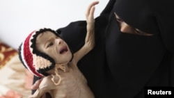 A woman holds her malnourished child at a feeding center at al-Sabyeen hospital in Yemen's capital, Sanaa, June 20, 2012.