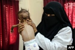 A nurse holds a malnourished child at a treatment centre in the village of Hays in Yemen's war-ravaged western province of Hodeida, on June 11, 2022.