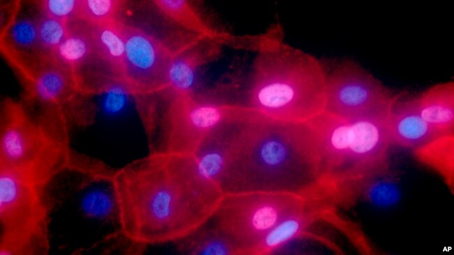 FILE - This undated fluorescence-colored microscope image made available by the National Institutes of Health in September 2016 shows a culture of human breast cancer cells. (Ewa Krawczyk/National Cancer Institute via AP)