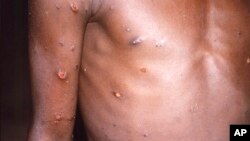 ARCHIVO - En esta imagen de 1997 proporcionada por los Centros para el Control y la Prevención de Enfermedades se muestra el brazo derecho y el torso de una persona con un caso activo de viruela símica.